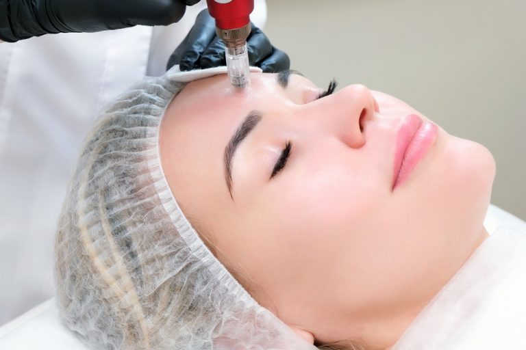 microneedling-kasia-fernandez-laser-skin-specialist